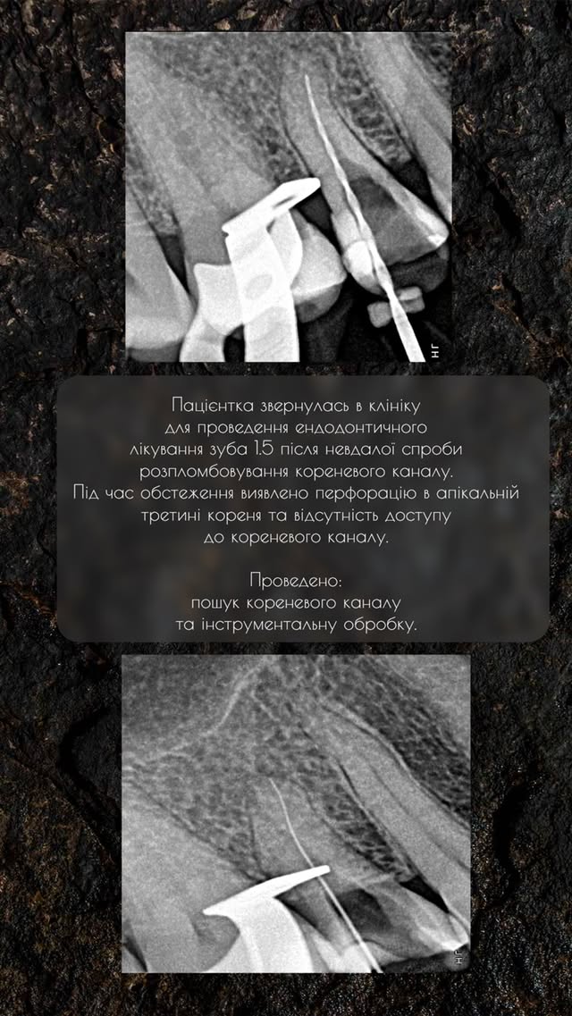 Ендодонтичне перелікування зуба 1.5